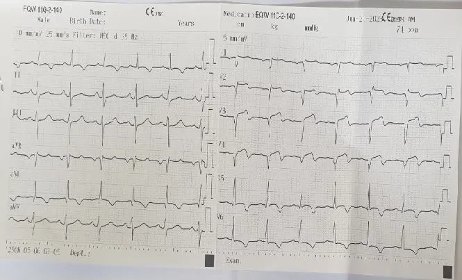 Một người đàn ông đi khám sức khỏe tình cờ phát hiện hẹp khít mạn tính động mạch vành do hút thuốc lá nhiều năm