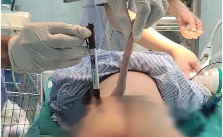 Phẫu thuật thành công bệnh nhi được chẩn đoán thoát vị mỡ – tủy – màng tủy vùng cùng cụt