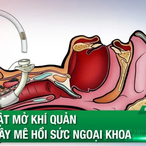 Thủ thuật mở khí quản trong gây mê hồi sức ngoại khoa