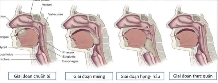 Rối loạn nuốt và những điều cần biết