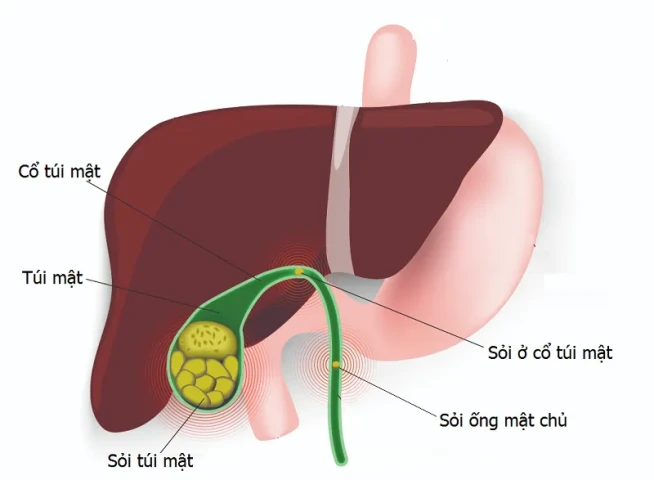 Những điều cần biết về sỏi túi mật