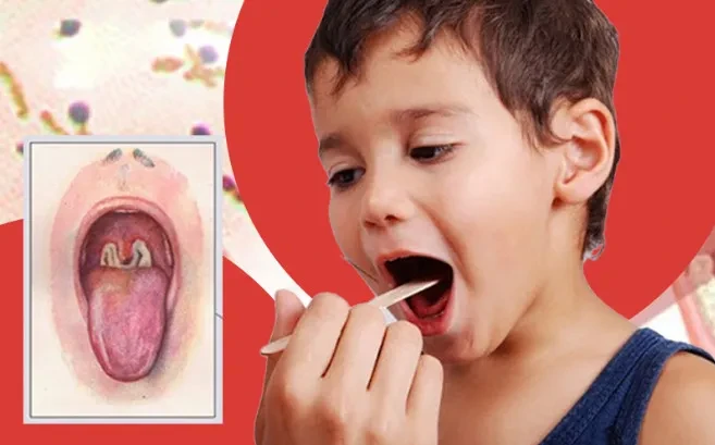 Bệnh bạch hầu – phát hiện, chẩn đoán và xử trí cần biết