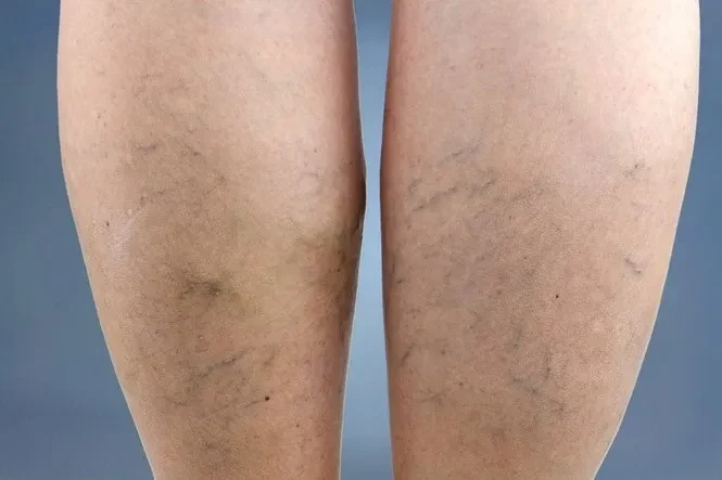 Những điều cần biết về bệnh suy tĩnh mạch chi dưới