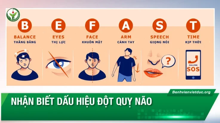 Nhận biết dấu hiệu đột quỵ não