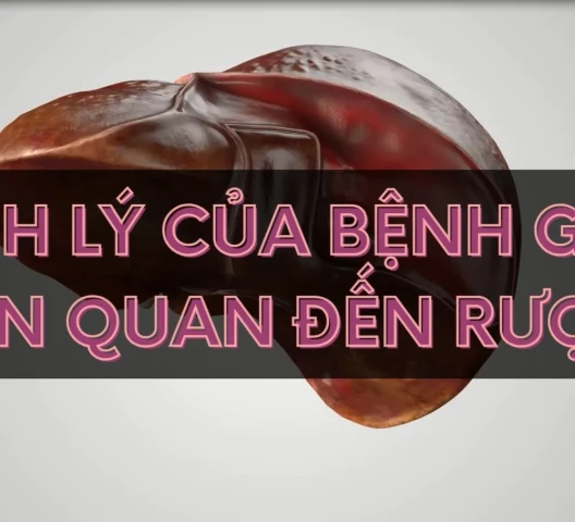 Bệnh lý của bệnh gan liên quan đến rượu
