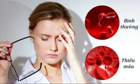 Thiếu máu do thiếu sắt