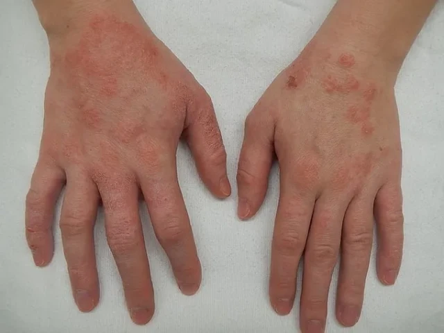 Dấu hiệu nhận biết viêm da tiếp xúc dị ứng