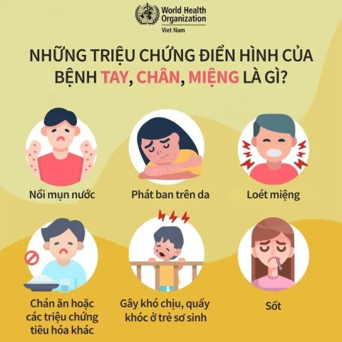 Những triệu chứng điển hình và cách phòng tránh bệnh tay chân miệng