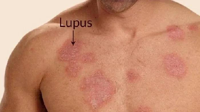 Chế độ dinh dưỡng cho bệnh nhân Lupus ban đỏ hệ thống