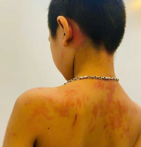 Gia đình tự ý cho con uống 11 loại thuốc để chữa ho khiến trẻ bị phản vệ
