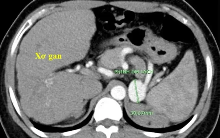 Cấp cứu bệnh nhân nữ uống thuốc lá không rõ nguồn gốc để điều trị viêm gan virus B mạn tính