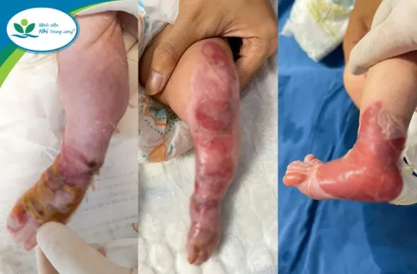 Bé gái 13 ngày tuổi mắc chứng bệnh ly thượng bì bọng nước bẩm sinh