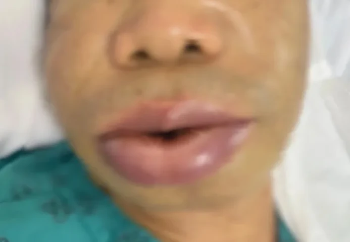 Tìm hiểu về bệnh phù mạch di truyền
