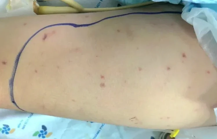Bé gái 5 tuổi nguy kịch do viêm não mô cầu