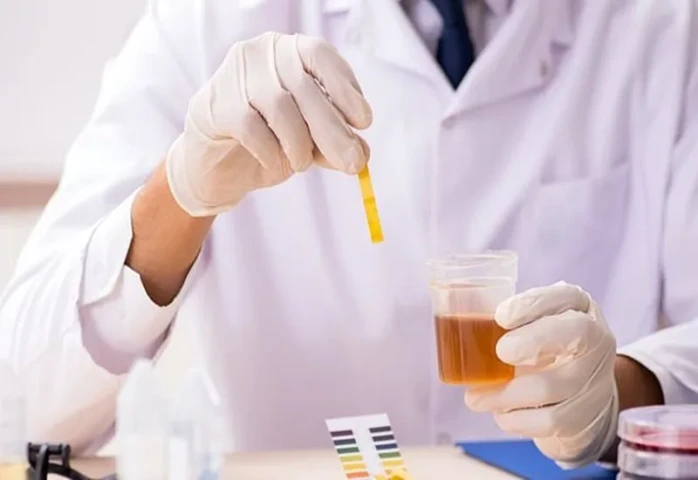 Xét nghiệm nước tiểu giúp phát hiện những bệnh nào?