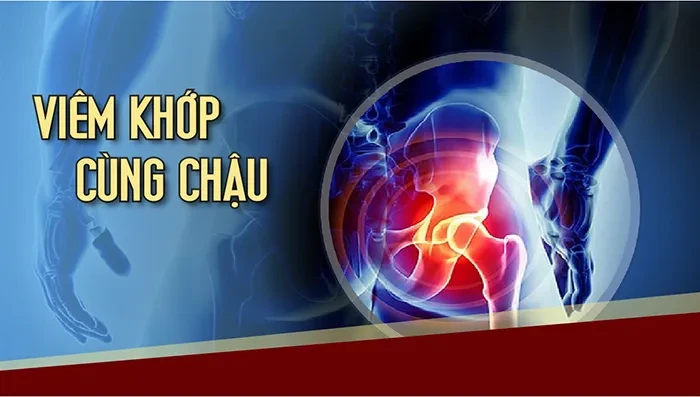 Viêm khớp cùng chậu