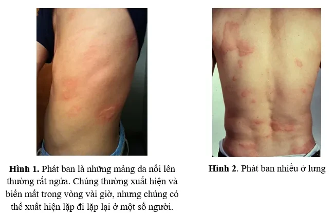 Tìm hiểu về phát ban mạn tính