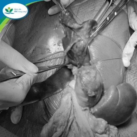 Trẻ bị thoát vị hoành bẩm sinh kèm theo thận lạc chỗ trên lồng ngực và phổi biệt lập được phẫu thuật thành công