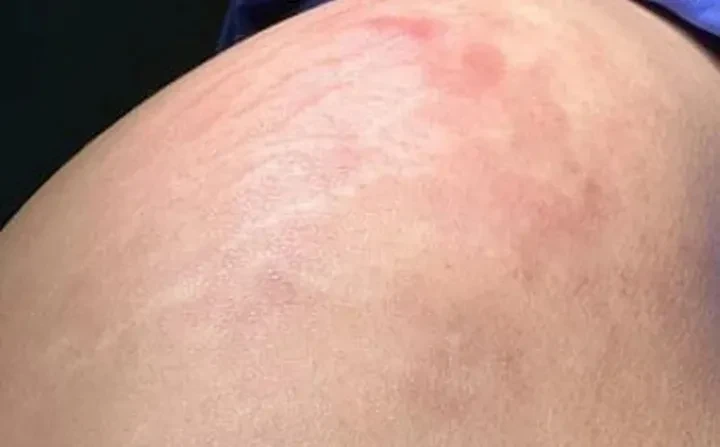 Cô gái bị áp-xe mông sau khi tiêm filler 4 năm trước