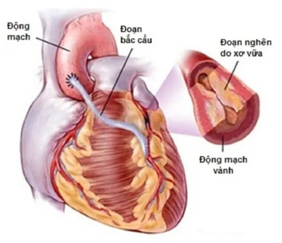 Chế độ dinh dưỡng cho người bệnh sau phẫu thuật bắc cầu tim