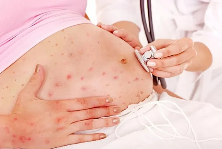 Bệnh thủy đậu và thai kỳ