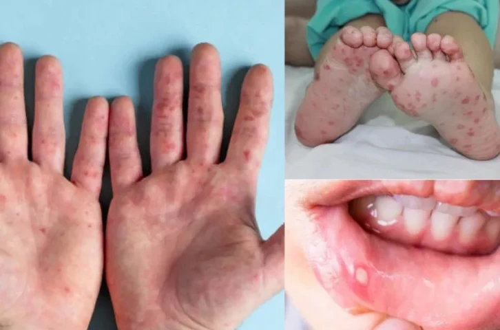 Những bệnh thường gặp vào mùa nắng nóng ở trẻ nhỏ