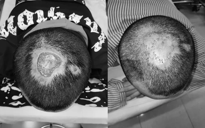 Chuyên gia cảnh báo nguy hại từ việc tẩy tóc