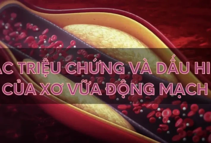 Các triệu chứng dấu hiệu của xơ vữa động mạch