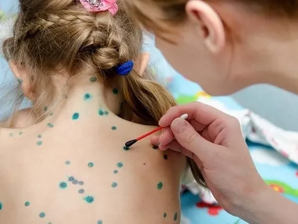 5 điều cha mẹ cần biết về bệnh thủy đậu – Chia sẻ từ chuyên gia truyền nhiễm
