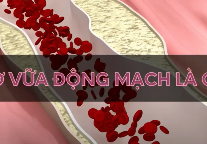 Xơ vữa động mạch là gì?