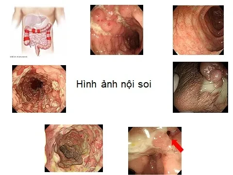 Crohn là bệnh viêm mạn tính đường tiêu hoá với nhiều yếu tố nguy cơ