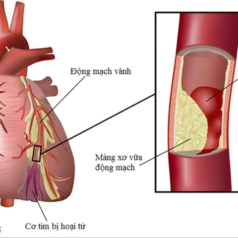 Khám bệnh mạch vành như thế nào?