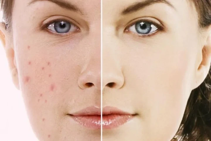 10 cách trị sẹo mụn trên mặt