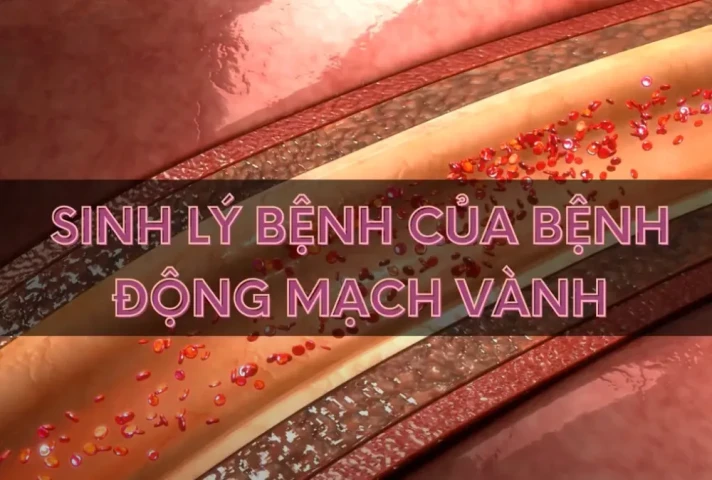 Sinh lý bệnh của bệnh động mạch vành