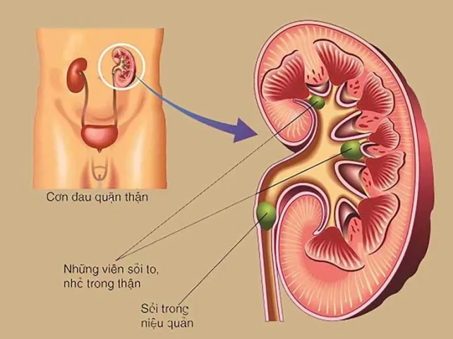 Những điều cần biết về bệnh sỏi đường tiết niệu