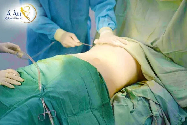 Các phương pháp giảm mỡ thẩm mỹ được ứng dụng nhiều hiện nay