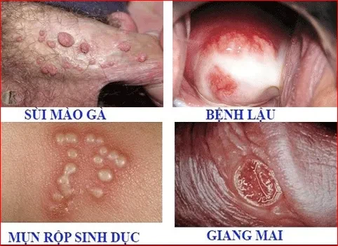 Các bệnh lây nhiễm qua đường tình dục và cách phòng tránh