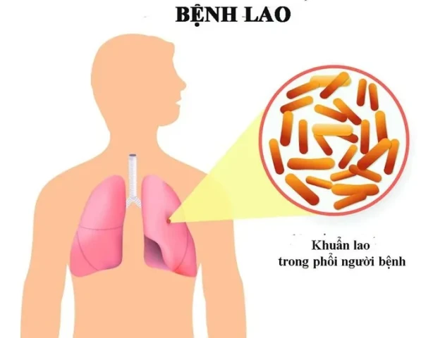 Thủ tướng chỉ đạo tăng cường công tác phòng, chống bệnh Lao