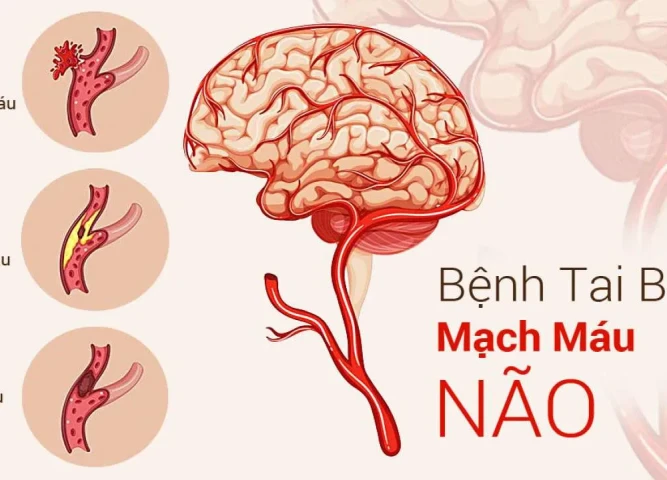 Phương thuốc phục hồi sau tai biến mạch máu não bằng Nam y