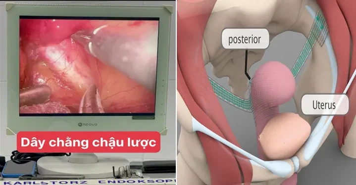 Phẫu thuật nội soi treo sàn chậu vào dây chằng chậu lược 2 bên