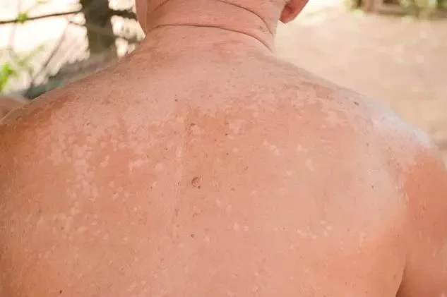 Triệu chứng và cách điều trị nấm ngoài da