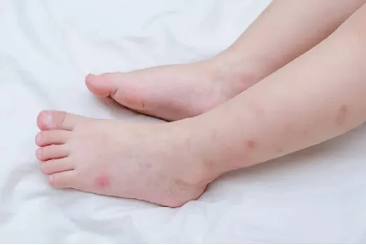 Những điều cần biết về viêm da cơ địa ở trẻ nhỏ