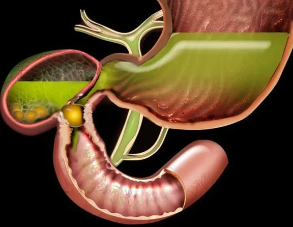 Tắc tá tràng do sỏi túi mật (hội chứng Bouveret)