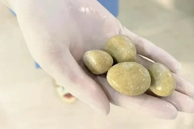 4 viên sỏi kích cỡ khổng lồ trong bàng quang của 1 bệnh nhân nam 40 tuổi