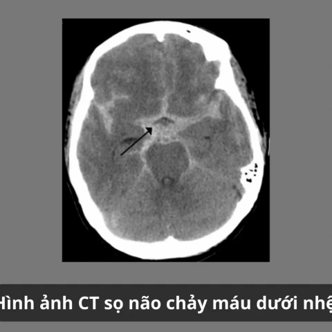Sự nguy hiểm của vỡ phình mạch não