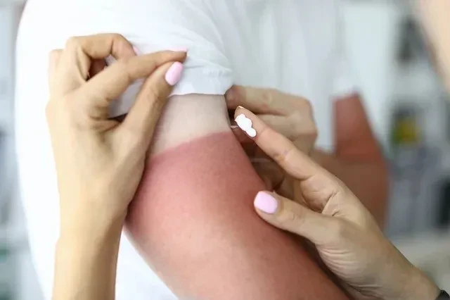 Thuốc mỡ trị bỏng: 7 lựa chọn tốt nhất và khi nào nên sử dụng