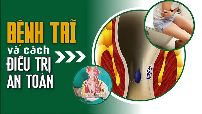 Bệnh trĩ và cách điều trị an toàn