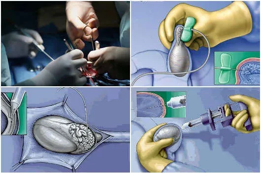 Các kỹ thuật thu nhận tinh trùng từ mào tinh