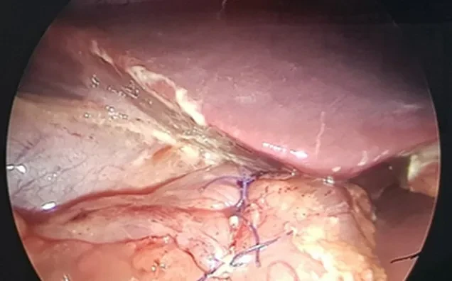 Bệnh nhi viêm phúc mạc do thủng dạ dày bởi thói quen ăn đồ chua, cay
