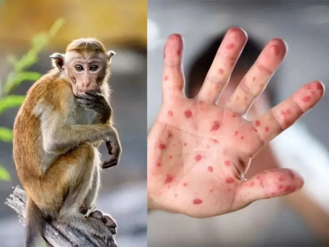 Bộ Y tế yêu cầu tăng cường phòng, chống bệnh đậu mùa khỉ sau khi phát hiện liên tiếp 2 ca bệnh